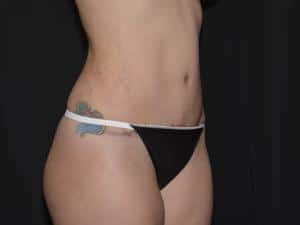 Tummy Tuck