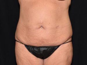 Before Image: Body Contouring After Weight Loss Surgery
