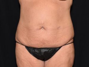 Body Contouring After Weight Loss Surgery