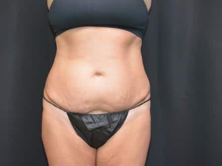 Before Image: Tummy Tuck - front