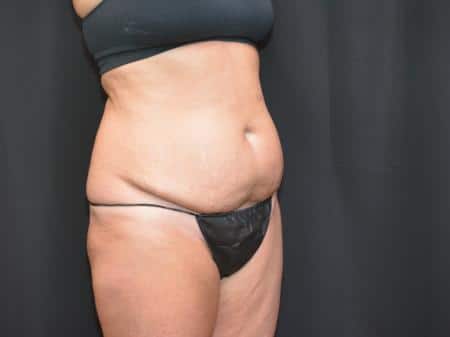 Before Image: Tummy Tuck - right-front-oblique