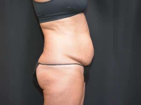 Before Image: Tummy Tuck - right-side