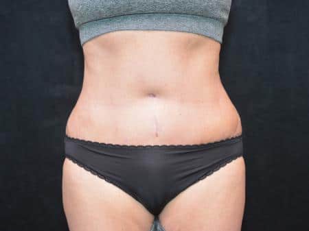 After Image: Tummy Tuck - front