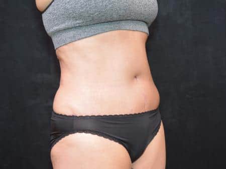 After Image: Tummy Tuck - right-front-oblique