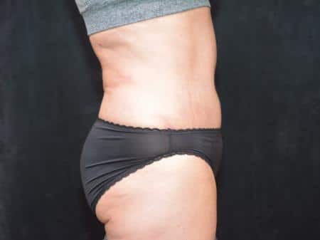 After Image: Tummy Tuck - right-side