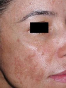 Before Image: Fraxel