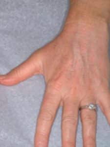 After Image: Fraxel