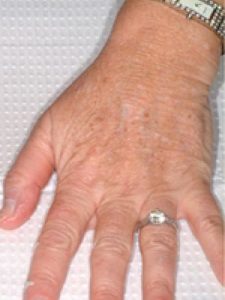 Before Image: Fraxel