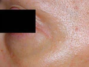 After Image: Fraxel - left-front-oblique