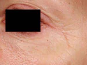 Before Image: Fraxel - left-front-oblique