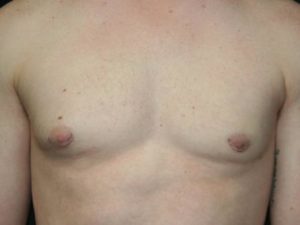 Male Breast Surgery