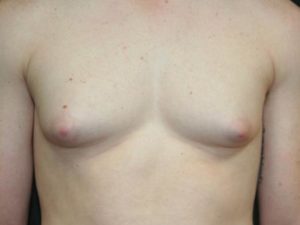 Male Breast Surgery