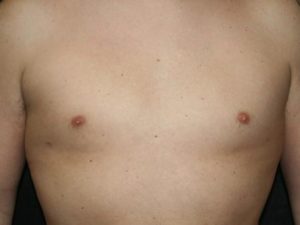 Male Breast Surgery