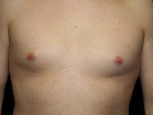 Male Breast Surgery