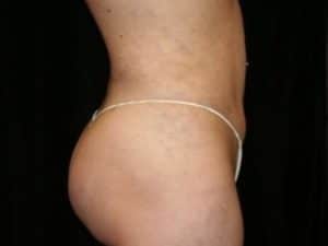 After Image: Buttock Reshaping