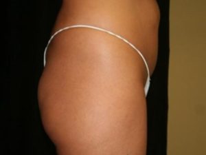 Before Image: Buttock Reshaping
