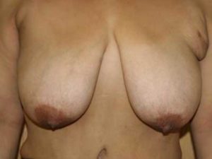 Before Image: Breast Reduction