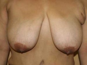 Breast Reduction