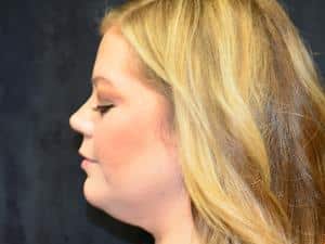 Kybella