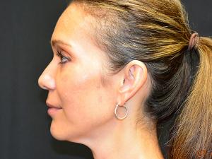 Kybella