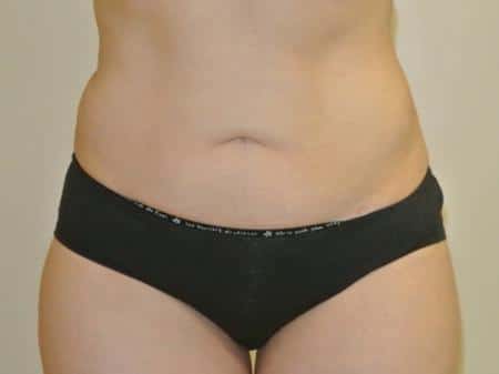 After Image: Liposuction - front
