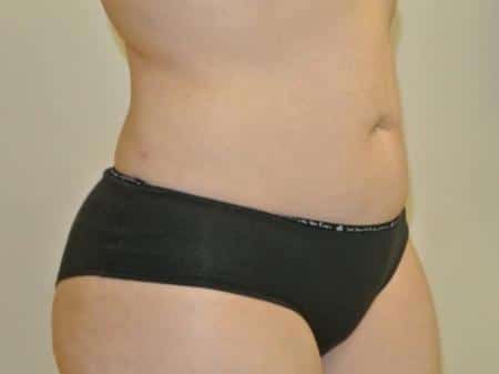 After Image: Liposuction - right-front-oblique