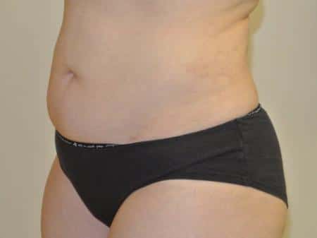 After Image: Liposuction - left-front-oblique