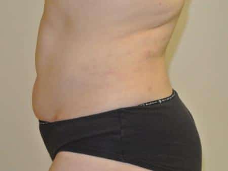 After Image: Liposuction - left-side