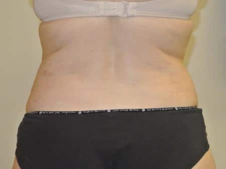 After Image: Liposuction - back