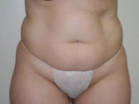 Before Image: Liposuction - front