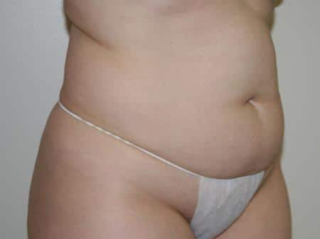 Before Image: Liposuction - right-front-oblique