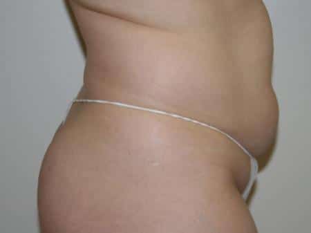 Before Image: Liposuction - right-side