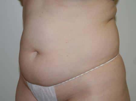 Before Image: Liposuction - left-front-oblique