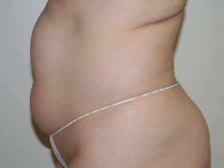 Before Image: Liposuction - left-side