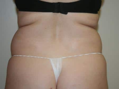 Before Image: Liposuction - back
