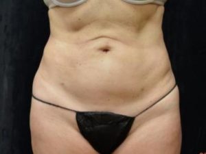 After Image: Liposuction