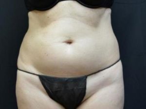 Before Image: Liposuction