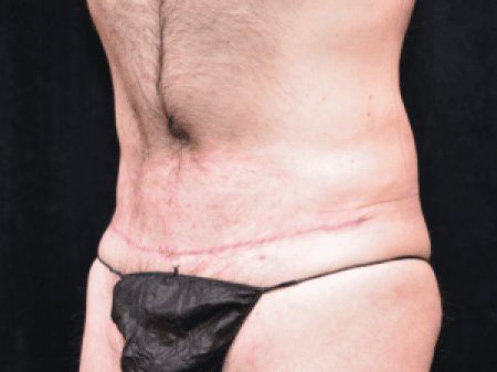 Body Contouring After Weight Loss Surgery