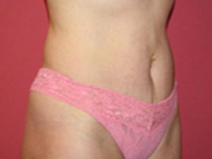 After Image: Smartlipo