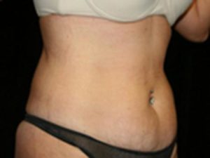 Before Image: Smartlipo