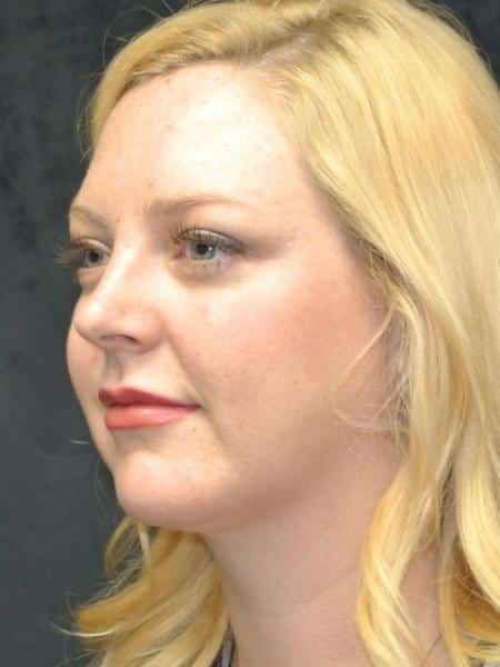 After Image: Smartlipo - left-front-oblique