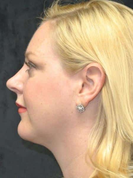 After Image: Smartlipo - left-side