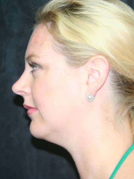 Before Image: Smartlipo - left-side