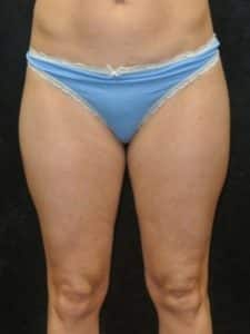 After Image: Smartlipo
