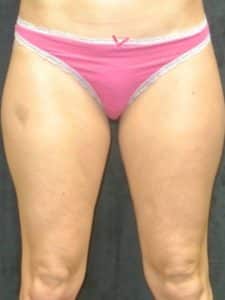 Before Image: Smartlipo
