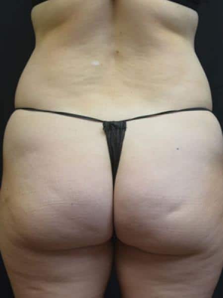 Before Image: Liposuction - back