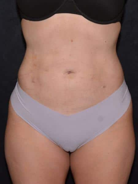 After Image: Liposuction - front