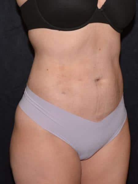After Image: Liposuction - right-front-oblique