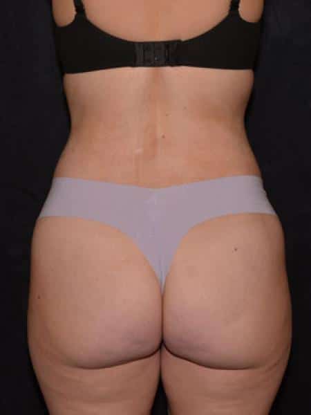 After Image: Liposuction - back