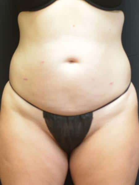 Before Image: Liposuction - front
